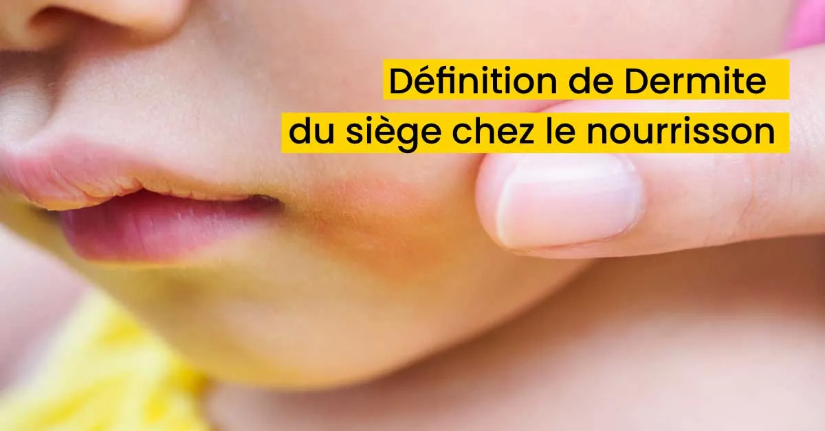 Définition de Dermite du siège chez le nourrisson